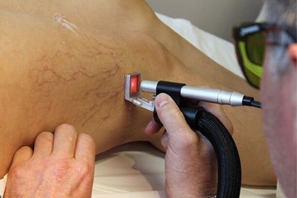 Laser treatment of varicose veins of the lower limbs