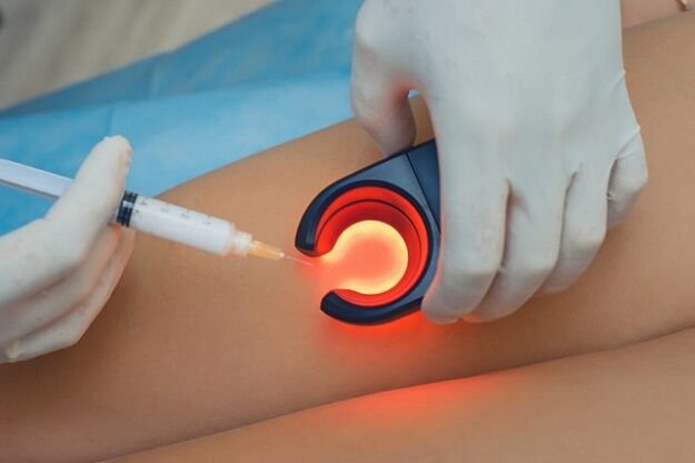 Treatment of varicose veins by sclerotherapy